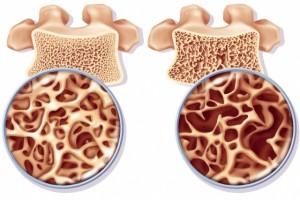 Osso normal (à esquerda) e Osso com Oeteoporose (à direita)
