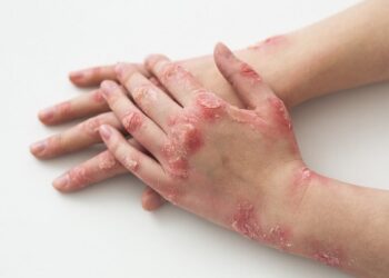 Psoríase: álcool e cigarro podem agravar o quadro da doença; entenda mais sobre a patologia